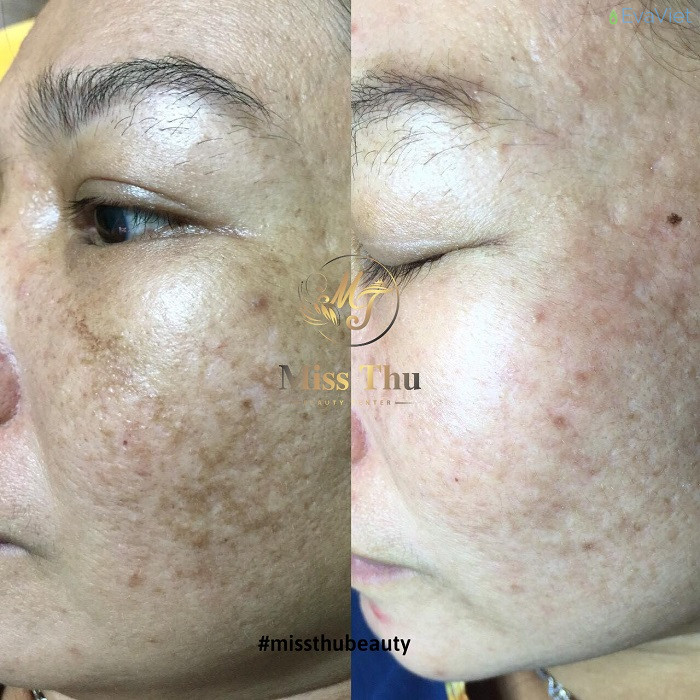 Địa điểm điều trị nám chất lượng tại Cao Lãnh Đồng Tháp